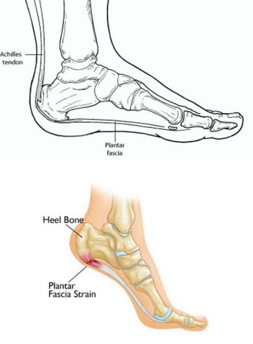Heel Pain Perth - Procare Podiatric Medicine & Surgery